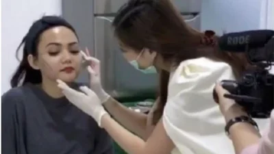 Hidung Baru Rina Nose: Transformasi Dramatik Usai Operasi di Klinik Dr. Tompi Bikin Netizen Terkagum